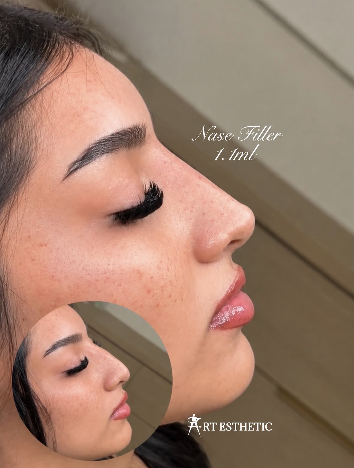 Elegant konturiertes Nasenprofil nach einer Filler-Behandlung bei MARÉ