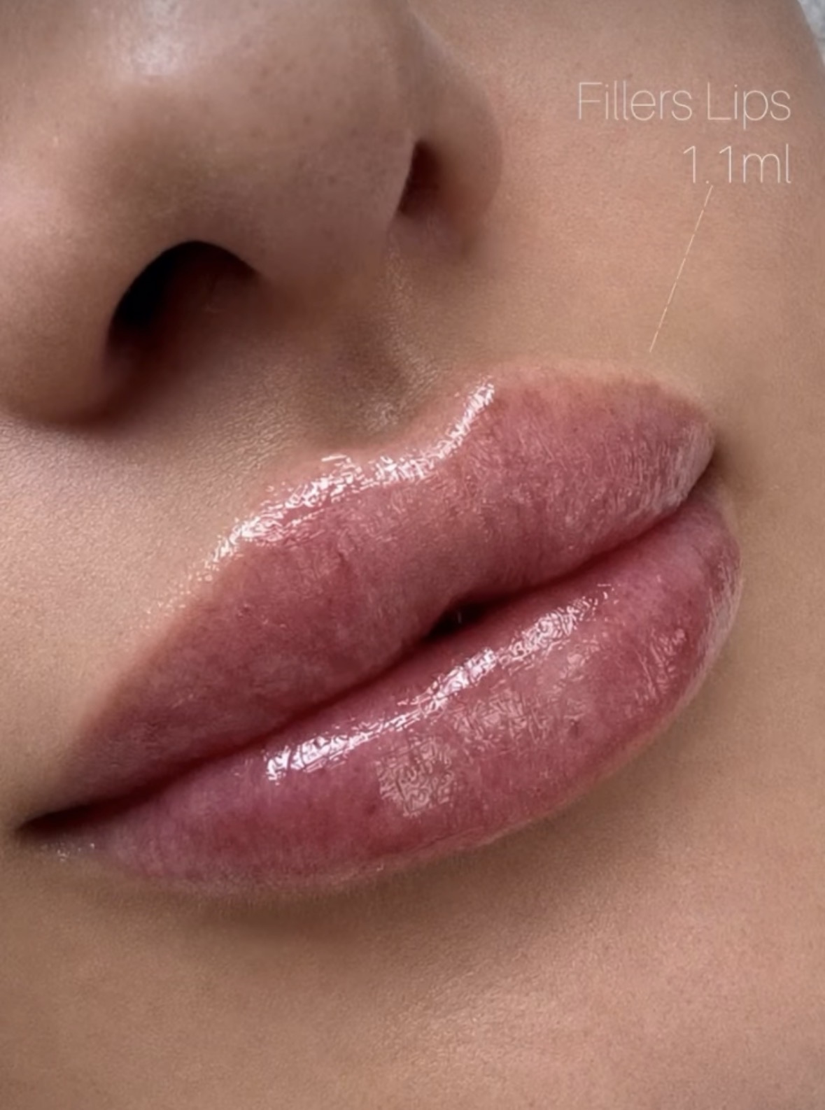 Natürlich wirkende, volle Lippen nach einer Hyaluron-Behandlung bei MARÉ